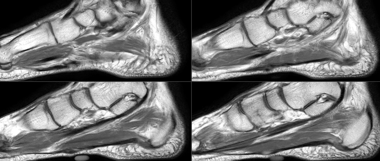 Figure 2 for case Plantar fibromatosis